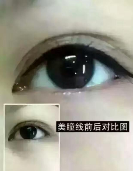 美瞳線是什么？什么樣的人適合做美瞳線？